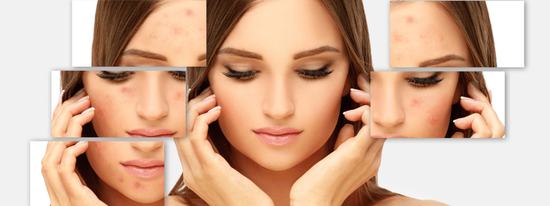 A legfontosabb bőrápolási hibák, amelyek pattanásokat okoznak – 1. rész
